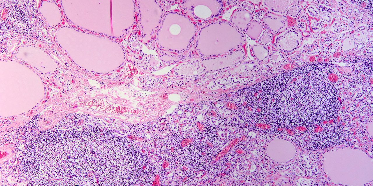 Hashimoto's thyroiditis with lymphoid infiltration. Autoantibodies against thyroid peroxidase and thyroglobulin were elevated. https://upload.wikimedia.org/wikipedia/commons/d/de/Hashimoto%27s_thyroiditis%2C_HE_4.jpg